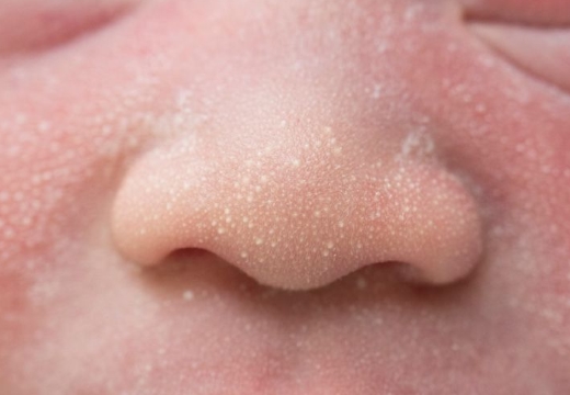 белые точки на лице новорожденного