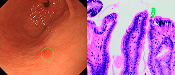Снимок ФГДС и биопсия язвы желудка при очаговом гастрите