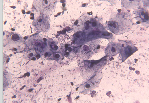 Койлоциты под микроскопом