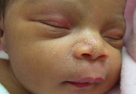 милиумы на лице новорожденного