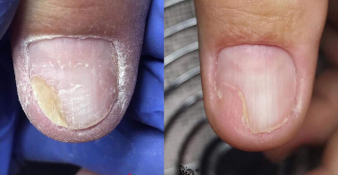 Онихолизис ногтей на руках после гель лака фото