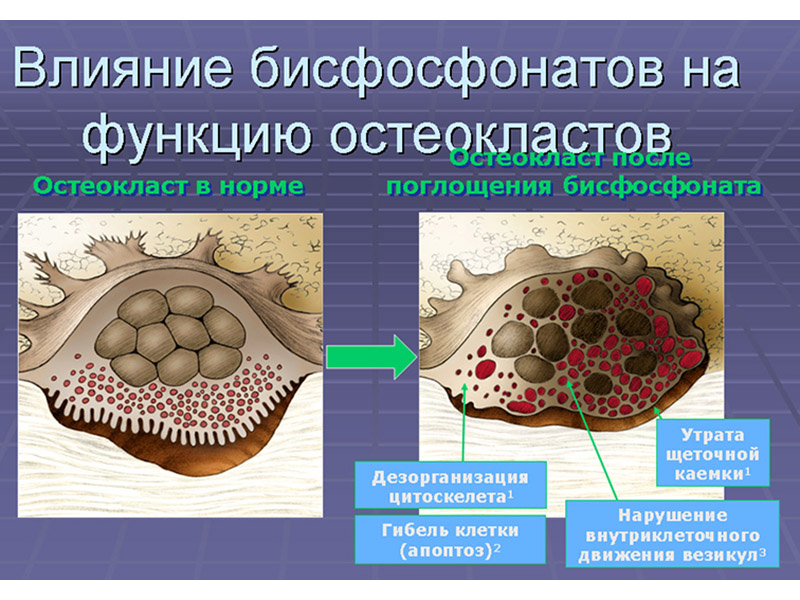 Бисфосфонаты