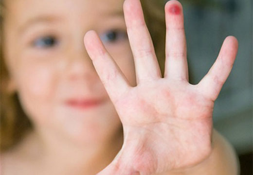 Красный нарост на детском пальце