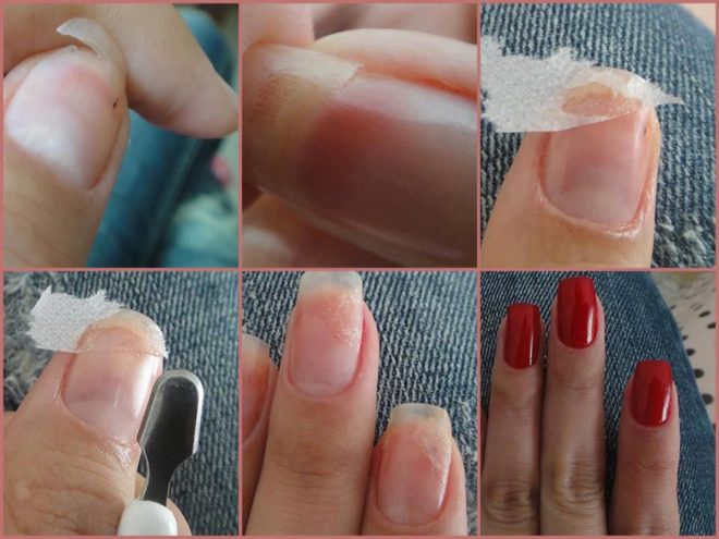 4 шага, что делать со сломанным ногтем
