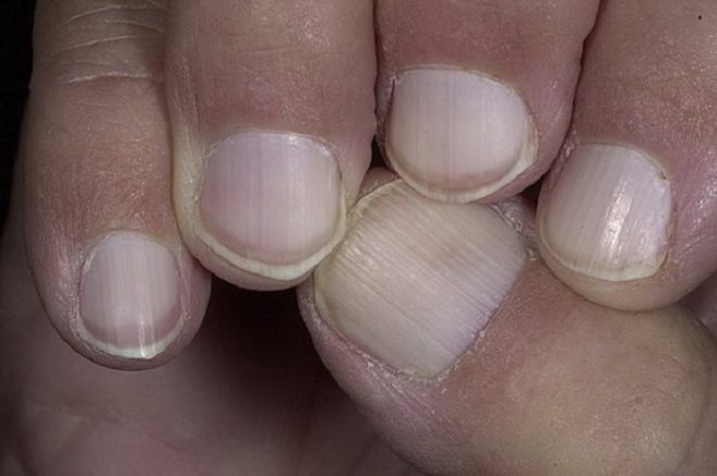 интересные факты о полосках на ногтях
