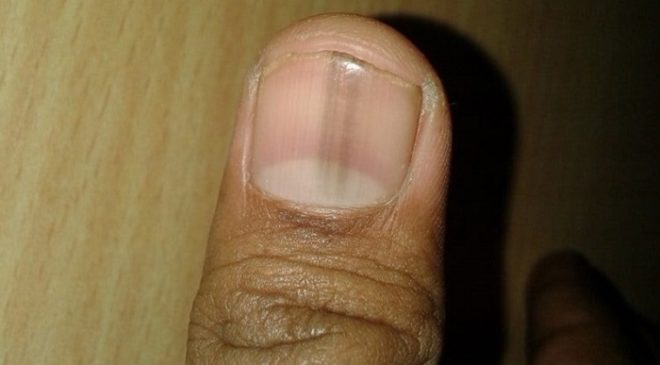 Почему возникают черные полосы на ногтях