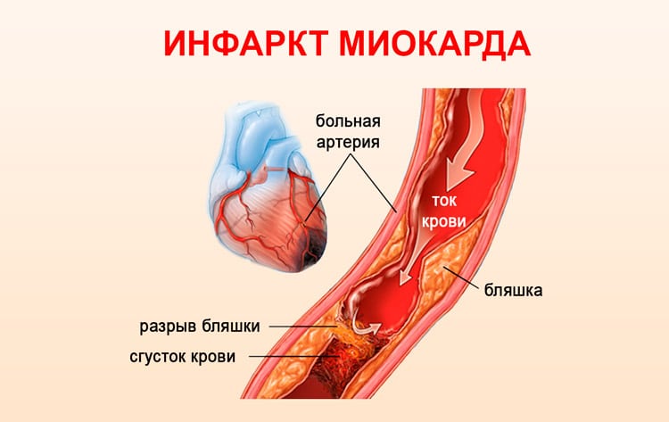 Что такое инфаркт миокарда