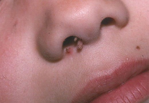 Бородавка внутри носа