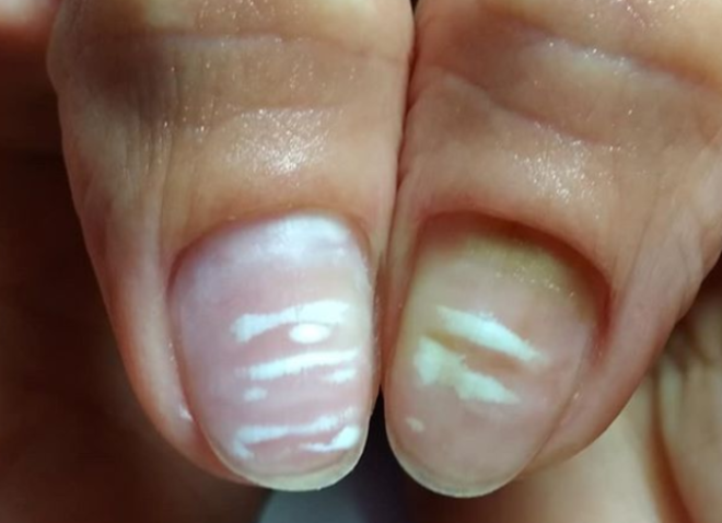 Почему ногти волнами на руках. Лейконихия (белые пятнышки). Лейконихия тотальная тотальная лейконихия. Белые линии на ногтях рук. Грибок ногтей белая полоска.