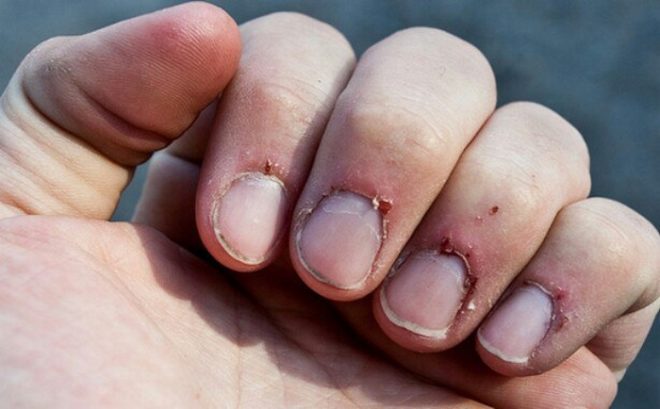 8 способов, как бросить грызть ногти на руках взрослому