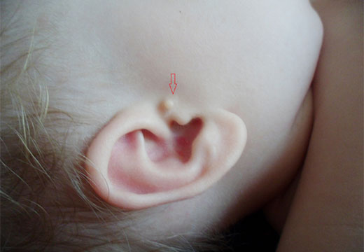папиллома у ребенка на ухе