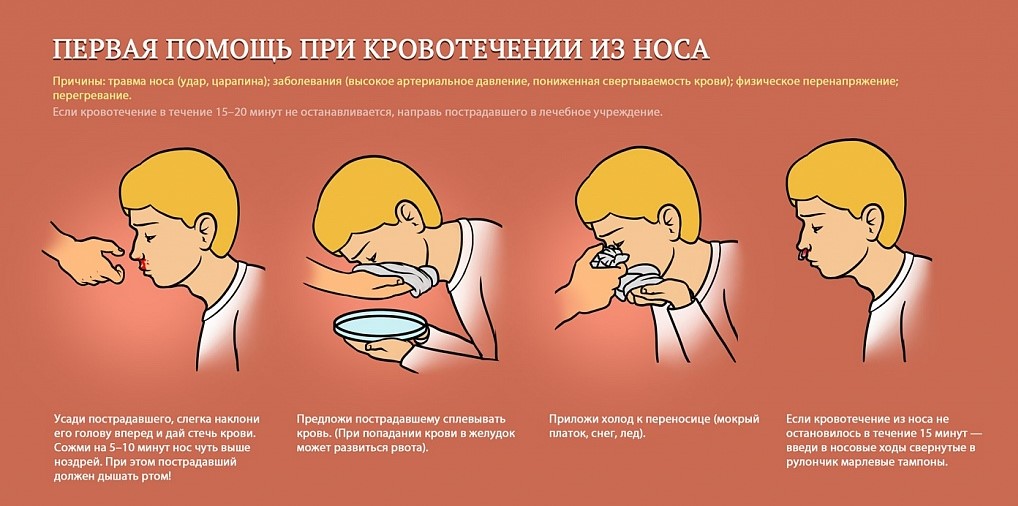 Первая помощь при кровотечении из носа