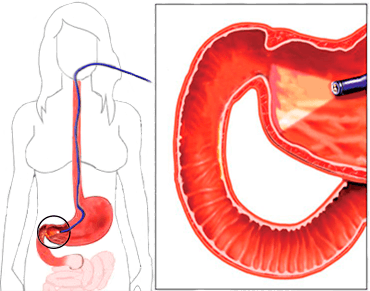 Фиброэзофагогастродуоденоскопия (ФГДС) желудка картинка