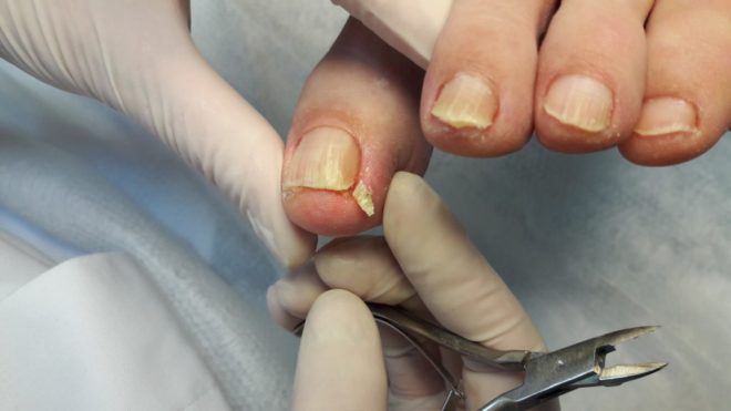 Способы лечения вросшего ногтя
