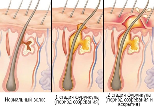 стадии развития фурункула
