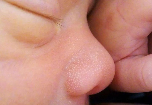 милии на носу новорожденого