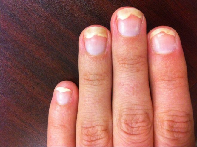 2 действенных способа лечения отслоения ногтя от ногтевого ложа
