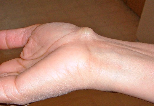 жировик на руке