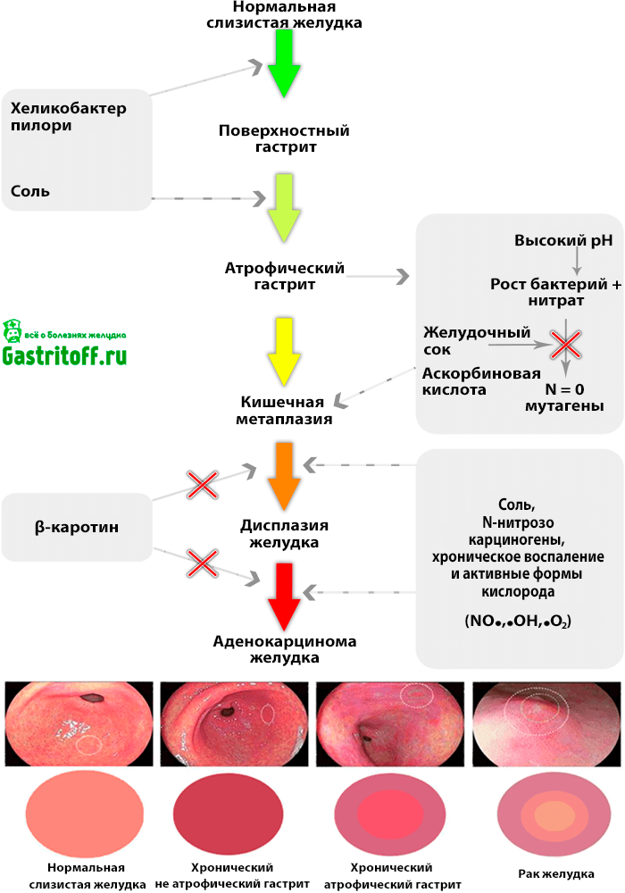Таблица - механизм действия от здорового желудка до рака