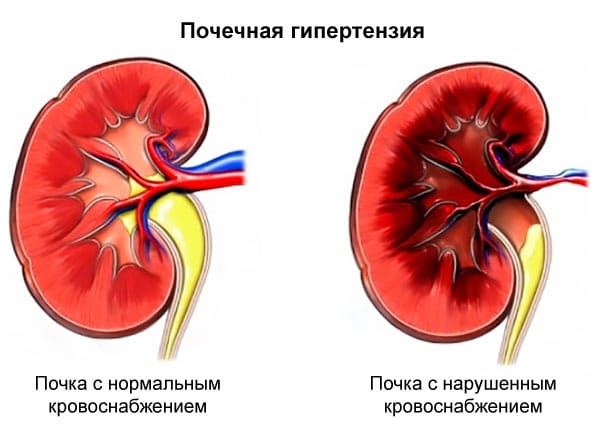 Состояние почек при нефрогенной артериальной гипертензии