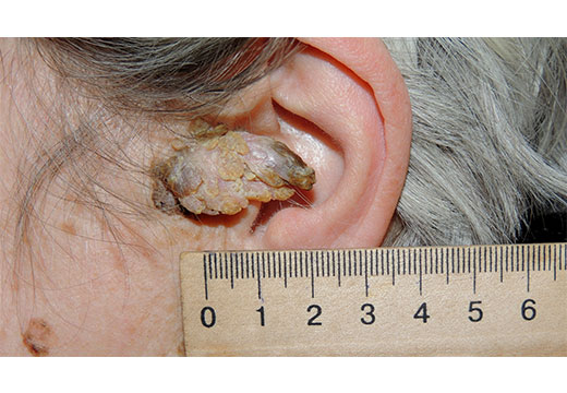 кератопапиллома наружного слухового прохода