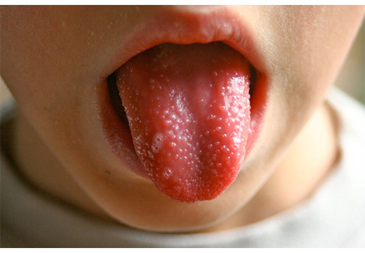 проявление ВПЧ на языке у ребенка
