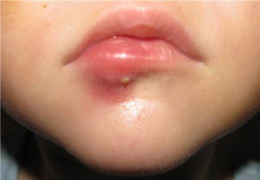 воспаление нижней губы