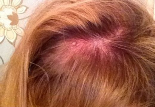 Причины появления фурункула на голове и его лечение