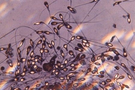 Техники получения сперматозоидов: биопсия и пункция яичка. (TESA и MESA)