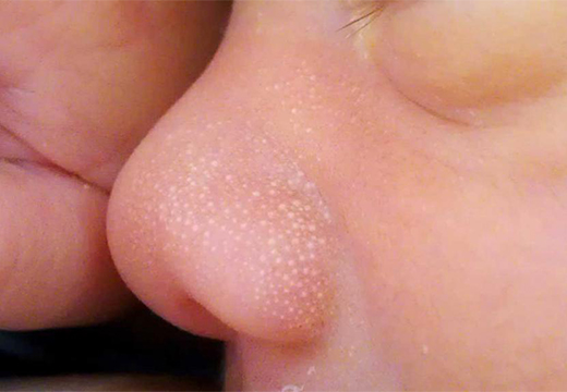 сыпь на детском носу
