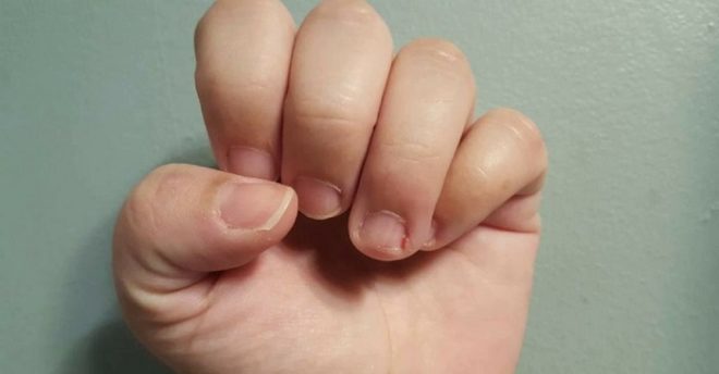Чем лечить заусенцы на пальцах