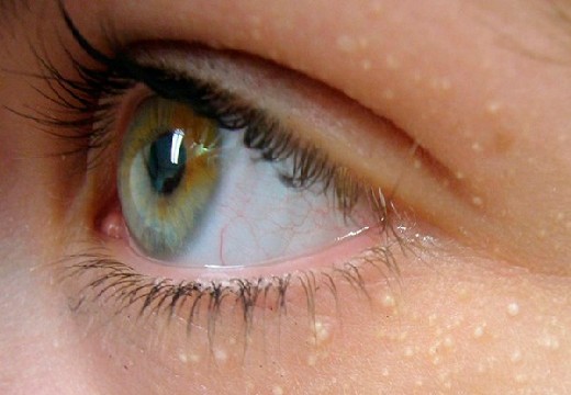 жировики вокруг глаз
